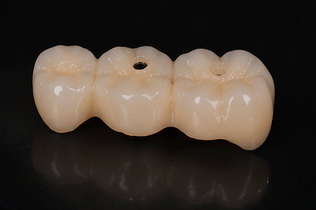 Matériau : Réhabilitation molaire sur implants