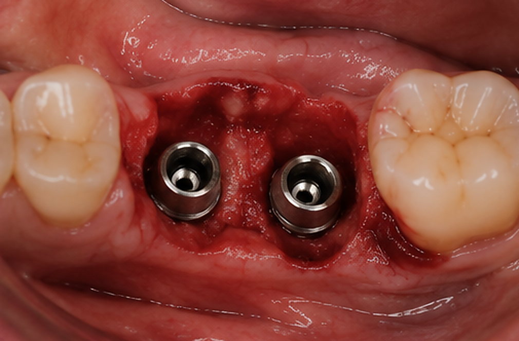 Les implants en place. Vue du site après mise en place des deux implants.