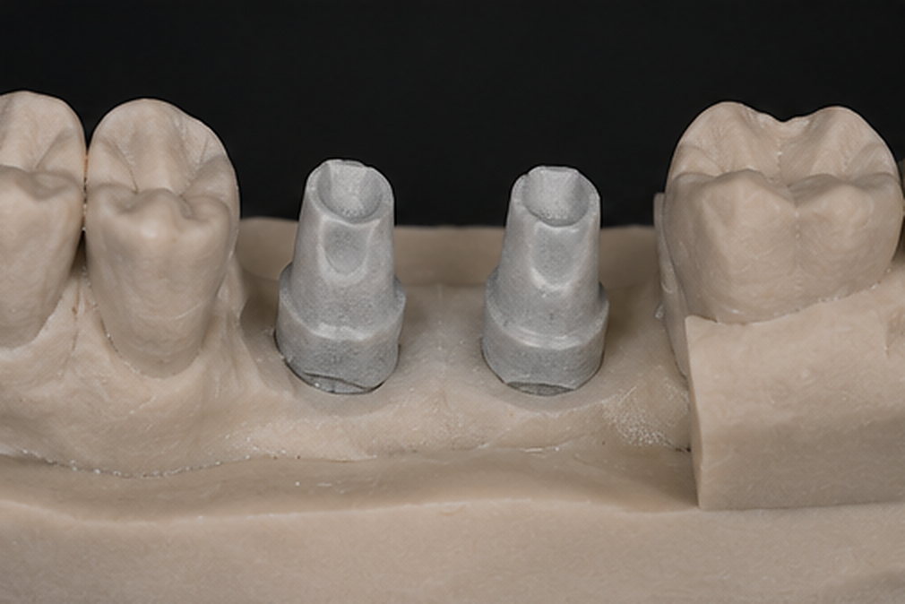 Points contrôlés : Réhabilitation molaire sur implants