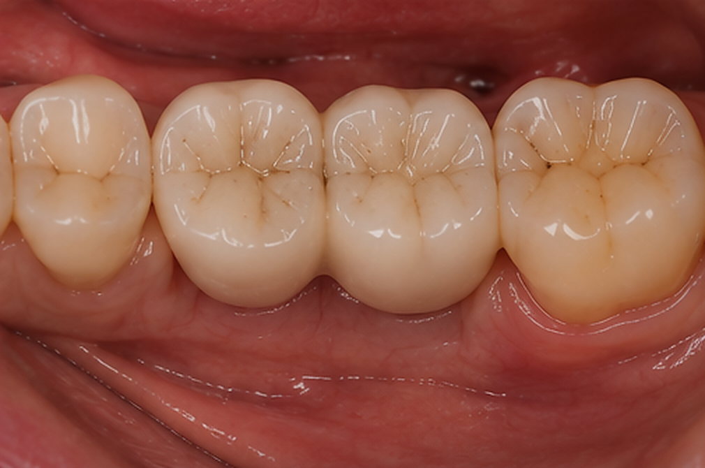 Résultat du cas : Réhabilitation molaire sur implants