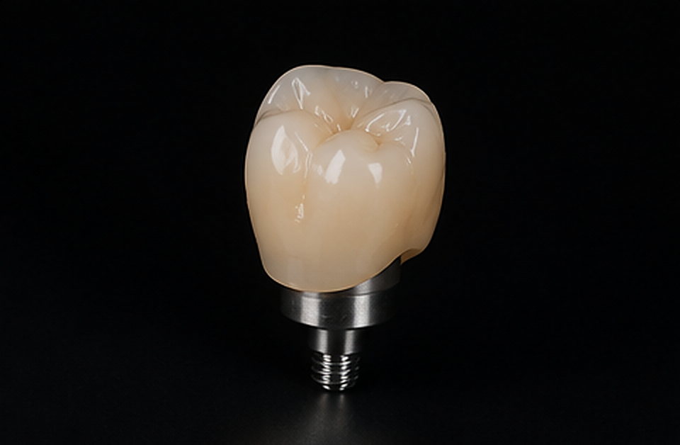 Matériau : Couronne unitaire sur implant