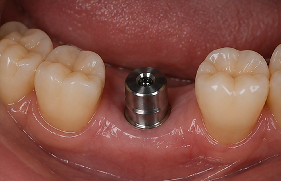 Problématique prothétique : Couronne unitaire sur implant