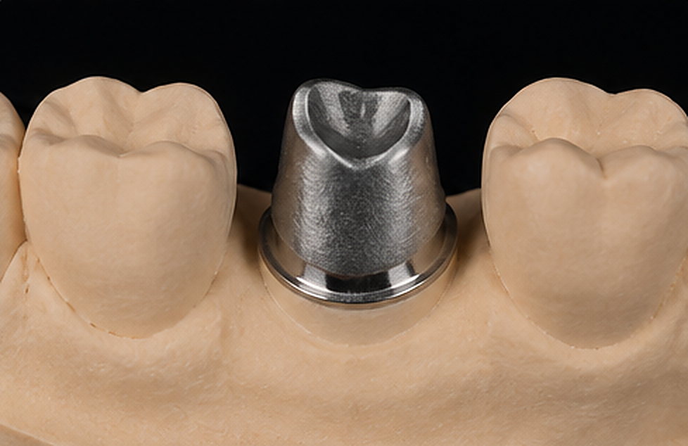 Solution retenue : Couronne unitaire sur implant