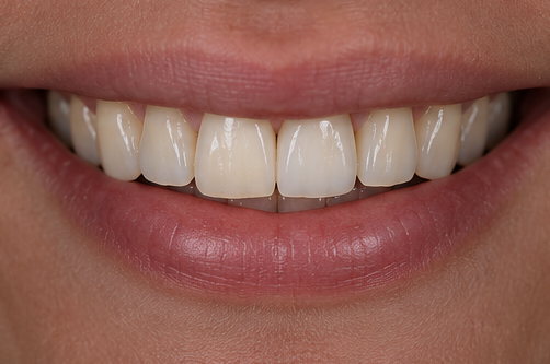 Le sourire terminé. Vue d'ensemble du sourire après pose.